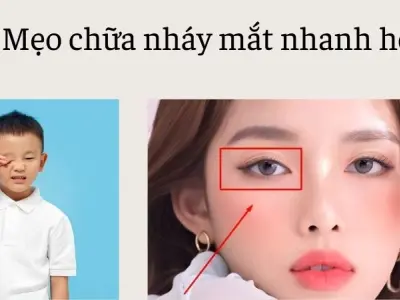 Mẹo chữa nháy mắt nhanh hết không cần dùng đến thuốc